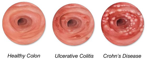 Inflammatory Bowel Disease