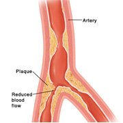 Causes of Angina Pectoris