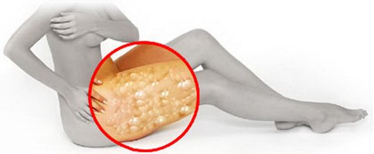 What Is Cellulite?