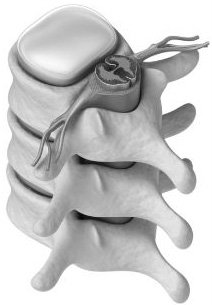 Causes of Herniated Disc