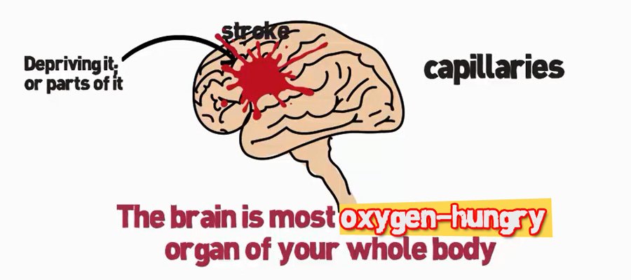 High Blood Pressure Cuases Stroke - You Must Learn To Keep Your Blood Pressure in Control.