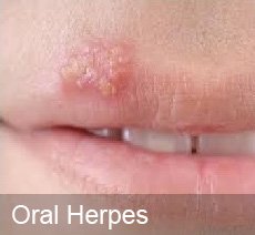 what does Herpes Look Like? - Oral Herpes