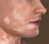 What Causes White Patches on Skin